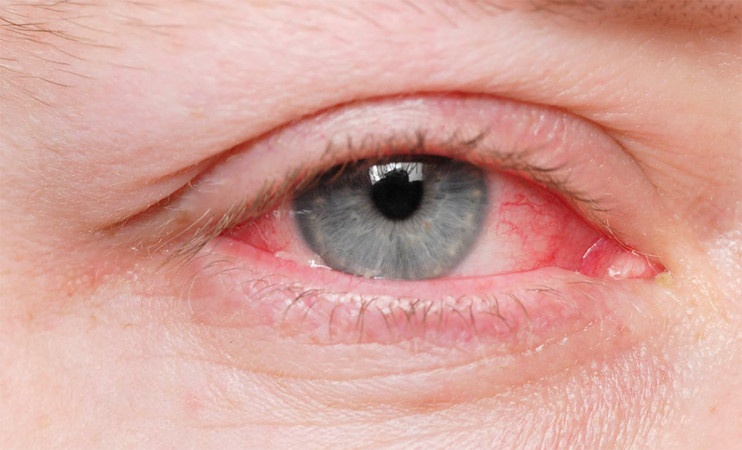 के भक्तपुरमा आँंखा पाक्ने रोग भयाबह हुन थालेको हो ? 